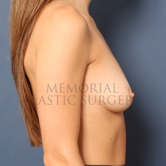 A side view before photo of patient 403 that underwent Breast Augmentation procedures at Memorial Plastic Surgery
