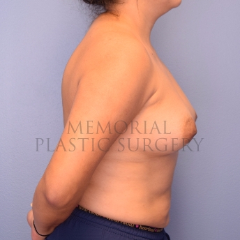 A side view before photo of patient 1257 that underwent Breast Augmentation procedures at Memorial Plastic Surgery
