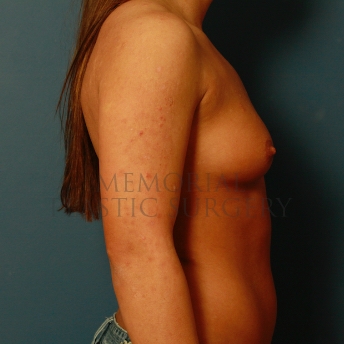 A side view before photo of patient 442 that underwent Breast Augmentation procedures at Memorial Plastic Surgery