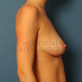A side view before photo of patient 126 that underwent Breast Augmentation procedures at Memorial Plastic Surgery