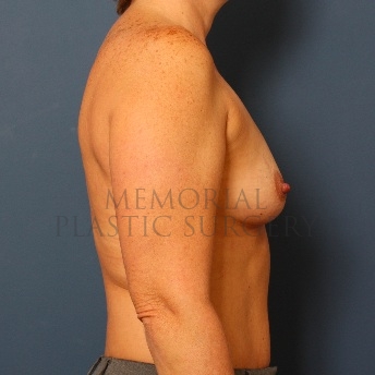 A side view before photo of patient 83 that underwent Breast Augmentation procedures at Memorial Plastic Surgery