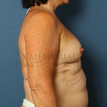 A side view before photo of patient 116 that underwent Breast Augmentation procedures at Memorial Plastic Surgery