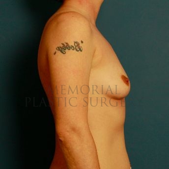 A side view before photo of patient 165 that underwent Breast Augmentation procedures at Memorial Plastic Surgery