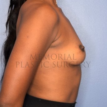 A side view before photo of patient 2412 that underwent Breast Augmentation procedures at Memorial Plastic Surgery