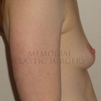 A side view before photo of patient 187 that underwent Breast Augmentation procedures at Memorial Plastic Surgery