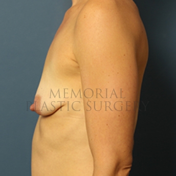 A side view before photo of patient 357 that underwent Breast Augmentation procedures at Memorial Plastic Surgery