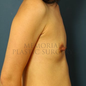 A side view before photo of patient 155 that underwent Breast Augmentation procedures at Memorial Plastic Surgery