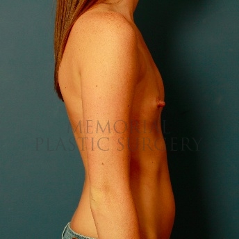 A side view before photo of patient 81 that underwent Breast Augmentation procedures at Memorial Plastic Surgery