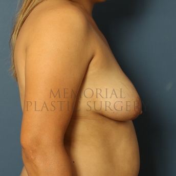 A side view before photo of patient 464 that underwent Breast Augmentation procedures at Memorial Plastic Surgery