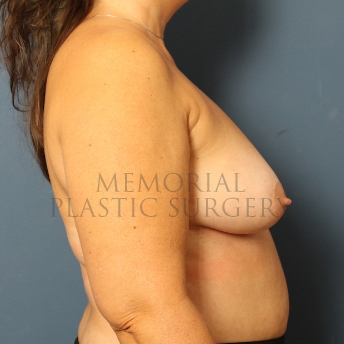A side view before photo of patient 457 that underwent Breast Augmentation procedures at Memorial Plastic Surgery