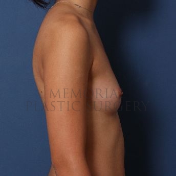A side view before photo of patient 121 that underwent Breast Augmentation procedures at Memorial Plastic Surgery