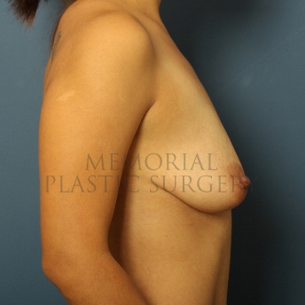A side view before photo of patient 431 that underwent Breast Augmentation procedures at Memorial Plastic Surgery
