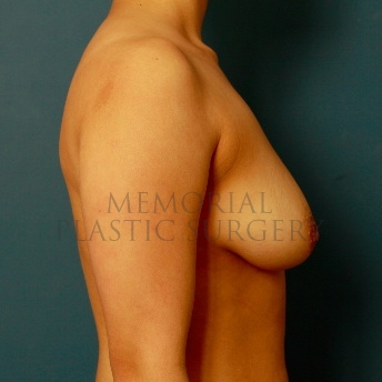 A side view before photo of patient 68 that underwent Breast Augmentation procedures at Memorial Plastic Surgery