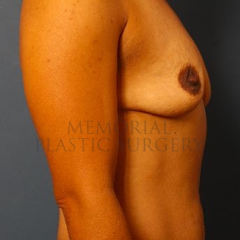 A side view before photo of patient 135 that underwent Breast Augmentation procedures at Memorial Plastic Surgery