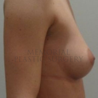 A side view before photo of patient 189 that underwent Breast Augmentation procedures at Memorial Plastic Surgery