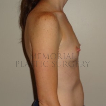 A side view before photo of patient 190 that underwent Breast Augmentation procedures at Memorial Plastic Surgery