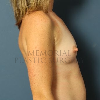 A side view before photo of patient 161 that underwent Breast Augmentation procedures at Memorial Plastic Surgery