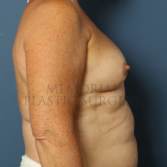 A side view before photo of patient 433 that underwent Breast Augmentation procedures at Memorial Plastic Surgery