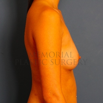 A side view before photo of patient 100 that underwent Breast Augmentation procedures at Memorial Plastic Surgery