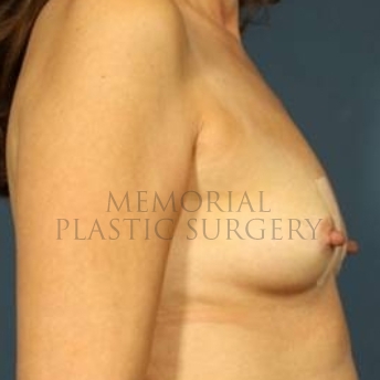A side view before photo of patient 178 that underwent Breast Augmentation procedures at Memorial Plastic Surgery