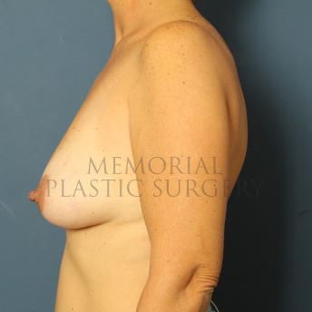 A side view before photo of patient 455 that underwent Breast Augmentation procedures at Memorial Plastic Surgery