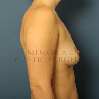 A side view before photo of patient 283 that underwent Breast Augmentation procedures at Memorial Plastic Surgery