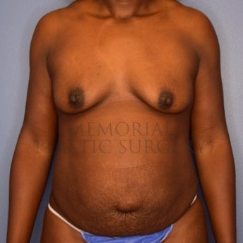A front view before photo of patient 2806 that underwent Breast Augmentation:Liposuction:Abdominoplasty Tummy Tuck:Mommy Makeover procedures at Memorial Plastic Surgery