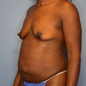 A oblique view before photo of patient 2806 that underwent Breast Augmentation:Liposuction:Abdominoplasty Tummy Tuck:Mommy Makeover procedures at Memorial Plastic Surgery