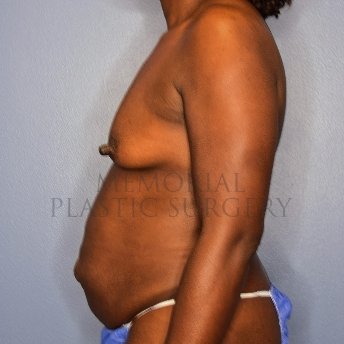 A side view before photo of patient 2806 that underwent Breast Augmentation:Liposuction:Abdominoplasty Tummy Tuck:Mommy Makeover procedures at Memorial Plastic Surgery