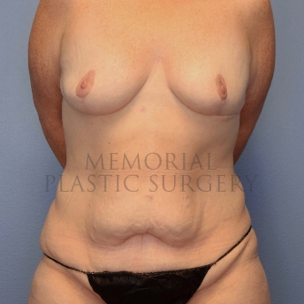 A front view before photo of patient 4109 that underwent Breast Augmentation:Mastopexy:Body Lift:Liposuction:Abdominoplasty Tummy Tuck:Mommy Makeover procedures at Memorial Plastic Surgery