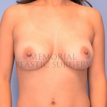 A front view after photo of patient 2222 that underwent Breast Augmentation:Revisional Breast Surgery procedures at Memorial Plastic Surgery