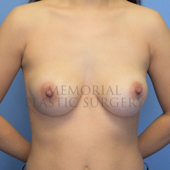 A front view before photo of patient 2222 that underwent Breast Augmentation:Revisional Breast Surgery procedures at Memorial Plastic Surgery