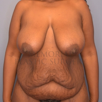 A front view before photo of patient 4108 that underwent Breast Reduction:Body Lift:Liposuction:Abdominoplasty Tummy Tuck:Mommy Makeover procedures at Memorial Plastic Surgery