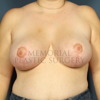 A front view after photo of patient 258 that underwent Breast Reduction procedures at Memorial Plastic Surgery
