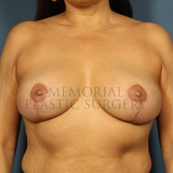 A front view after photo of patient 255 that underwent Breast Reduction procedures at Memorial Plastic Surgery