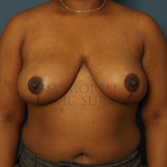 A front view after photo of patient 250 that underwent Breast Reduction procedures at Memorial Plastic Surgery
