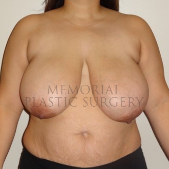 A front view before photo of patient 197 that underwent Breast Reduction procedures at Memorial Plastic Surgery