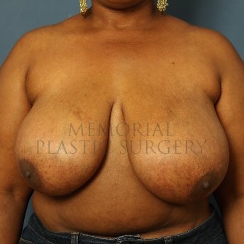 A front view before photo of patient 253 that underwent Breast Reduction procedures at Memorial Plastic Surgery