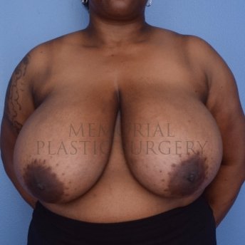 A front view before photo of patient 1243 that underwent Breast Reduction procedures at Memorial Plastic Surgery