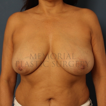A front view before photo of patient 255 that underwent Breast Reduction procedures at Memorial Plastic Surgery