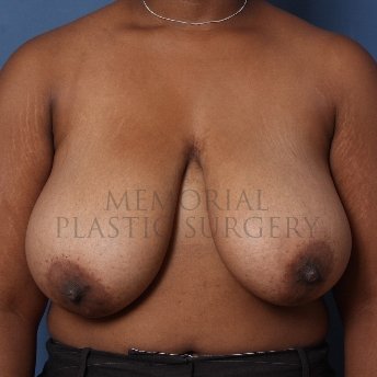 A front view before photo of patient 250 that underwent Breast Reduction procedures at Memorial Plastic Surgery