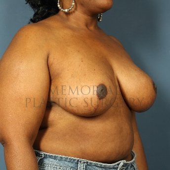 A oblique view after photo of patient 253 that underwent Breast Reduction procedures at Memorial Plastic Surgery