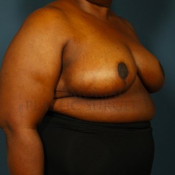 A oblique view after photo of patient 244 that underwent Breast Reduction procedures at Memorial Plastic Surgery