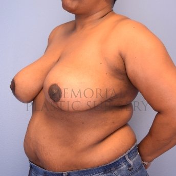 A oblique view after photo of patient 1243 that underwent Breast Reduction procedures at Memorial Plastic Surgery