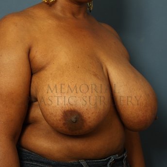 A oblique view before photo of patient 253 that underwent Breast Reduction procedures at Memorial Plastic Surgery