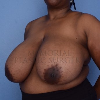 A oblique view before photo of patient 1243 that underwent Breast Reduction procedures at Memorial Plastic Surgery
