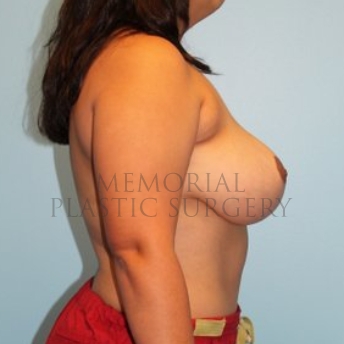 A side view after photo of patient 197 that underwent Breast Reduction procedures at Memorial Plastic Surgery