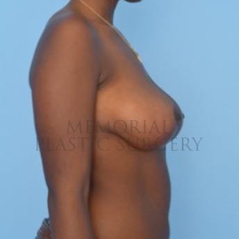 A side view after photo of patient 290 that underwent Breast Reduction procedures at Memorial Plastic Surgery