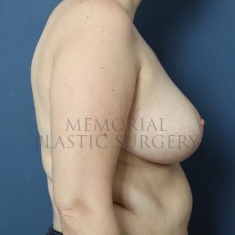 A side view after photo of patient 245 that underwent Breast Reduction procedures at Memorial Plastic Surgery
