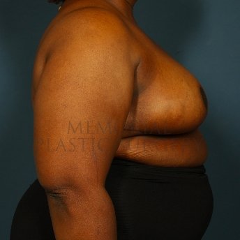 A side view after photo of patient 244 that underwent Breast Reduction procedures at Memorial Plastic Surgery